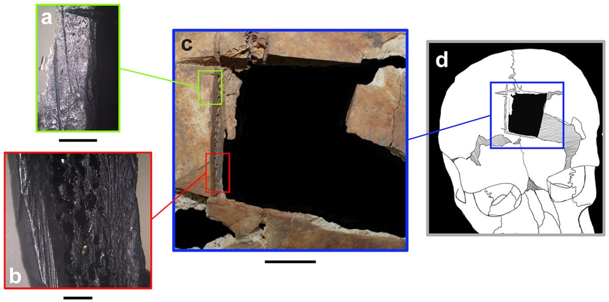 Evidence of brain surgery on a 3,000-year-old skull has been found by scientists